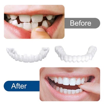 SnapOn Smile Dental Veneers - arabtijarah